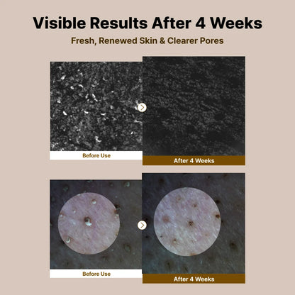 NIDA - Black Rice Blackhead Exfoliating Serum